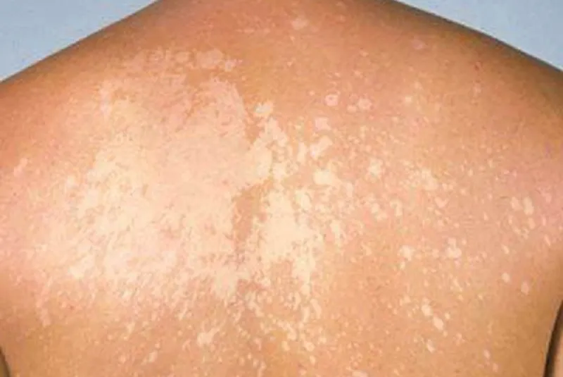 101+ hình ảnh của tinea Versolor, nhận biết sớm để điều trị hiệu quả 13