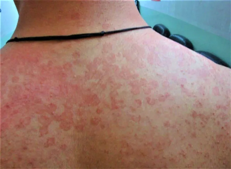 101+ hình ảnh của tinea Versolor, nhận biết sớm để điều trị hiệu quả 29