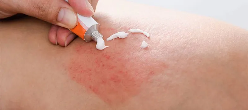 101+ hình ảnh của tinea Versolor, nhận biết sớm để điều trị hiệu quả 6