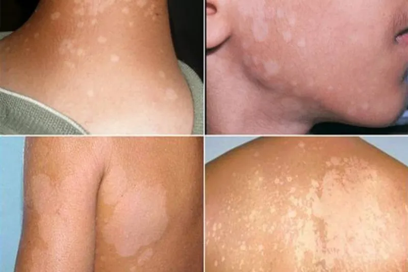 101+ hình ảnh của tinea Versolor, nhận biết sớm để điều trị hiệu quả 17